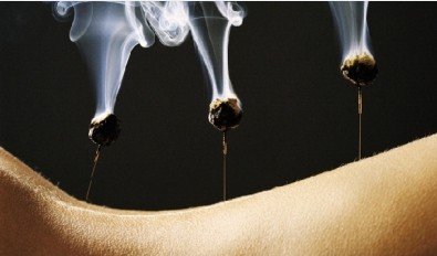 有关中医针灸减肥四个疑问