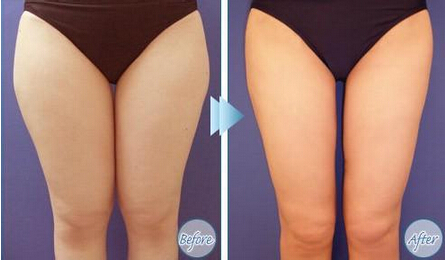 瘦小腿最有效的3种措施