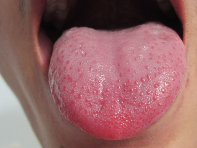 从舌头看身体健康 没有舌苔缺乏营养_寻医问药